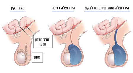 ניתוח בקע מפשעתי בילדים